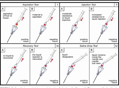 verse needle drop test|veres needle gas pressure.